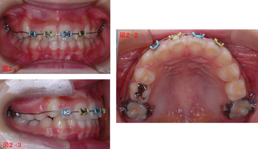 前歯の配列と出っ歯の改善中10歳9カ月の写真