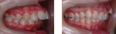 出っ歯（上顎前突）例の写真